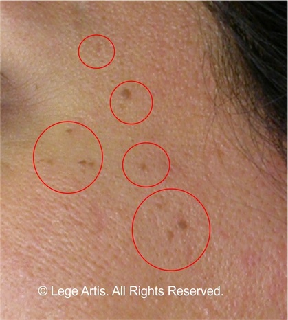 anal skin tag removal